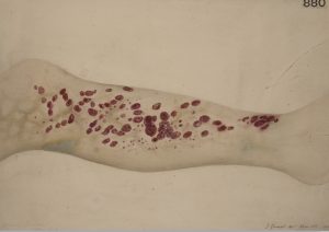 Leg of a patient with scorbutus (scurvy), 1887. By: Godart, Thomas . Courtesy of St Bartholomew's Hospital Archives & Museum, Wellcome Images.